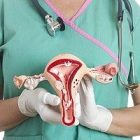 Le cancer des ovaires et sa relation avec le talc