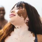Vitiligo : 1 % de la population touchée par cette maladie