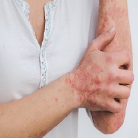 Une personne avec des signes de psoriasis sur la main et les bras
