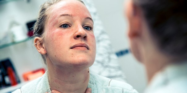 Une jeune femme qui a de l’eczéma sur le visage