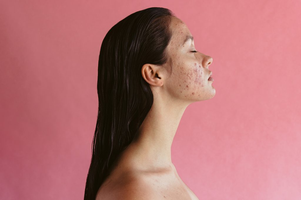 Une jeune femme avec une peau acnéique 